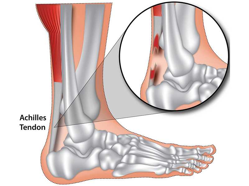 Achilles Tendon Diagram - Arizona Foot and Ankle Physicians Achilles Tendon Diagram