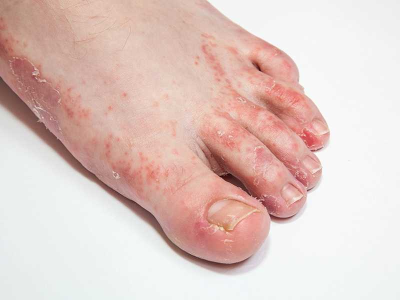 Effective Athlete's Foot Therapies by Expert Podiatrists - Arizona Foot and Ankle Physicians Athlete's foot treatment at Scottsdale podiatry clinic