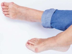 Bunion treatment at Arizona Foot Clinic