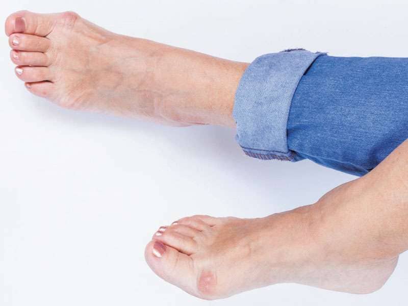 Bunion treatment at Arizona Foot Clinic