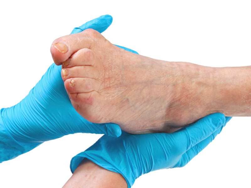 Advanced Bunion Therapies at Scottsdale Clinic - Arizona Foot and Ankle Physicians Bunion relief treatments in Arizona
