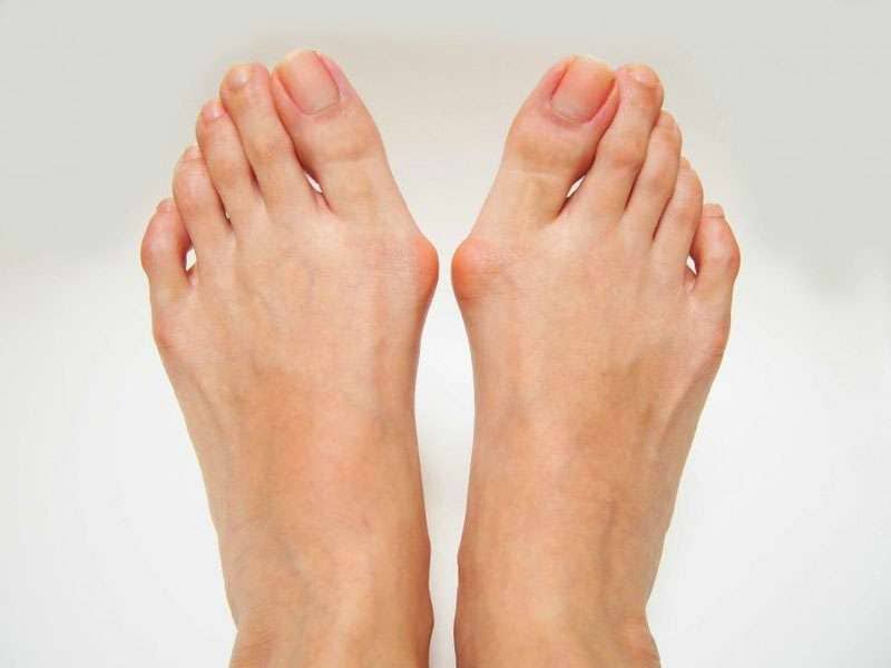 Bunion correction by Scottsdale podiatrists