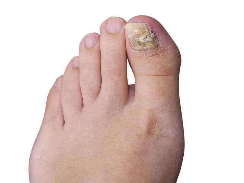 Fungal toenail treatment at Scottsdale clinic