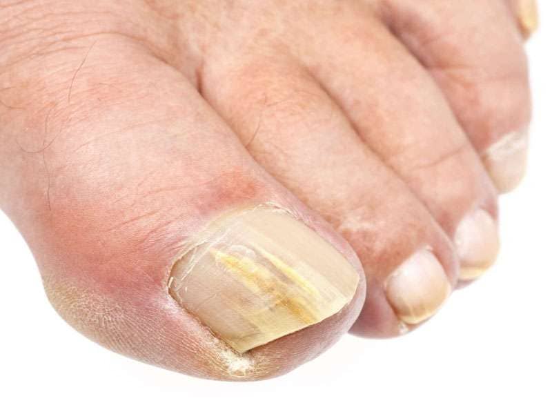 Toenail fungus treatment at Arizona podiatry clinic