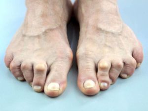 Hammertoe pain relief in Scottsdale