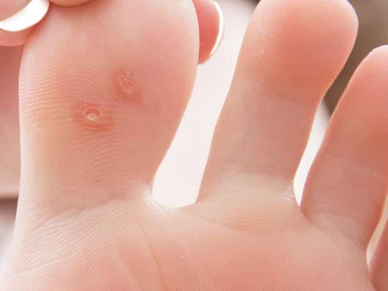 Effective Plantar Wart Treatments in Arizona - Arizona Foot and Ankle Physicians Plantar wart removal at Scottsdale foot clinic