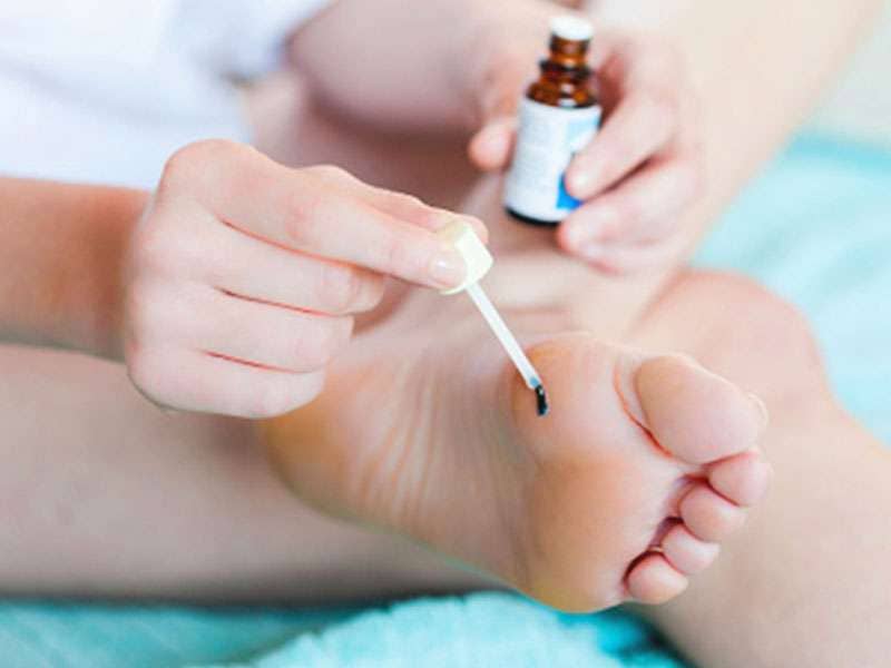 Scottsdale Plantar Wart Removal Specialists - Arizona Foot and Ankle Physicians Plantar wart removal in Arizona