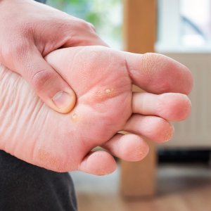 Corns And Calluses Treatments Near Me in Scottsdale, AZ