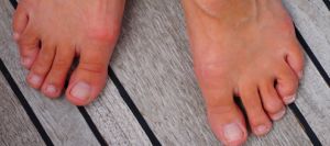 Hammertoes Treatment Near Me in Scottsdale, AZ Hammertoes Treatment Near Me in Scottsdale, AZ