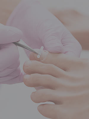Ingrown Toenails Near Me in Scottsdale, AZ