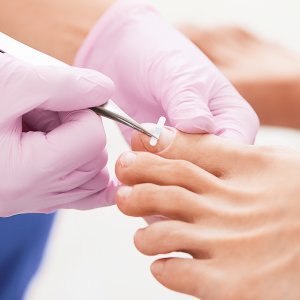 Ingrown Toenail Treatments Near Me in Scottsdale, AZ