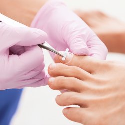 Ingrown Toenail Treatments Near Me in Scottsdale, AZ