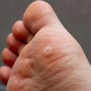 Plantar Wart Treatment Near Me in Scottsdale, AZ