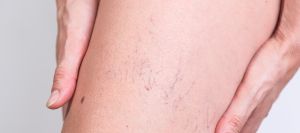 Effective Treatments for Poor Circulation in Feet in Scottsdale, AZ Effective Treatments for Poor Circulation in Feet in Scottsdale, AZ
