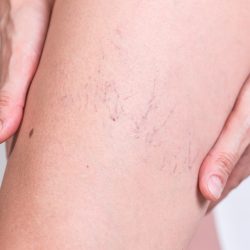 Poor Circulation Treatments Near Me in Scottsdale, AZ
